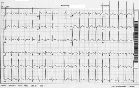 or Aflutter? AFib What is the rhythm?