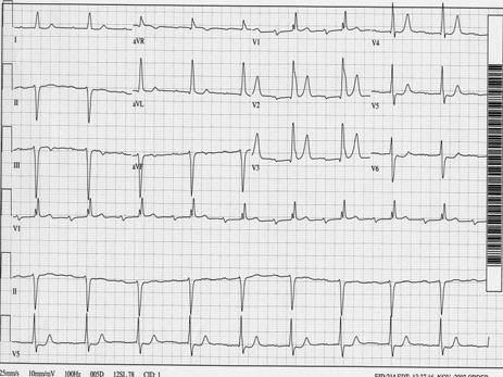 75 yo AA male presents with prolonged CP nonstemi & avr Prognostic Value of Lead avr in Patients with a First Non-ST segment Elevation Acute Myocardial Infarction 70.00% 60.00% 50.00% 40.00% 30.