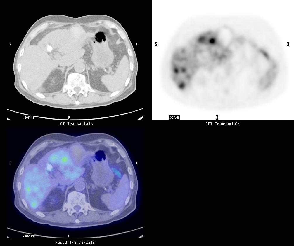 PET/CT in Oncology Hepatocellular Carcinoma Previous treatment with