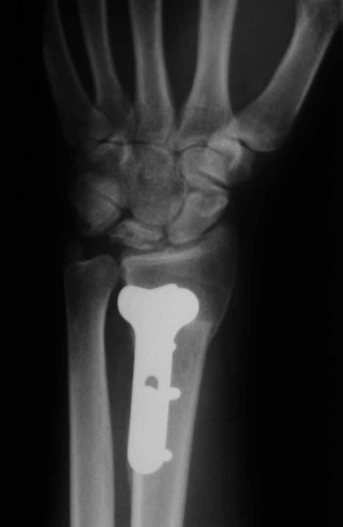 The final objective was to decompress the lunate by two mechanisms : 1) by levelling the distal radio-ulnar joint by means of a radial bone resection of maximum 4 mm to avoid inferior radioulnar