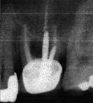 3 Fig. 1 Failing upper tooth 26. Fig. 2 Digital pantompograph few months after extraction.