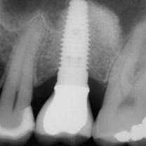 Discussion Severe local bone deficiency together with an altered gingival contour presented a real challenge in restoration of the area with an implant-supported prosthesis.
