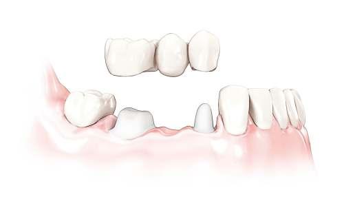 Your dentist has the solution that s right for you What are replacement teeth?