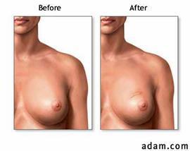 Mastectomy Modified Radical