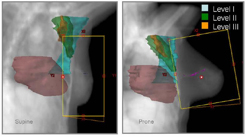 Patient positioning impacts radiation dose to the axilla Supine Prone On average, 50% less