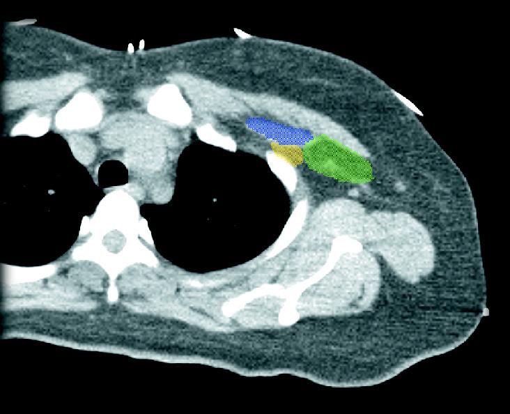 CT based contouring of at-risk lymph nodes Pectoralis Minor