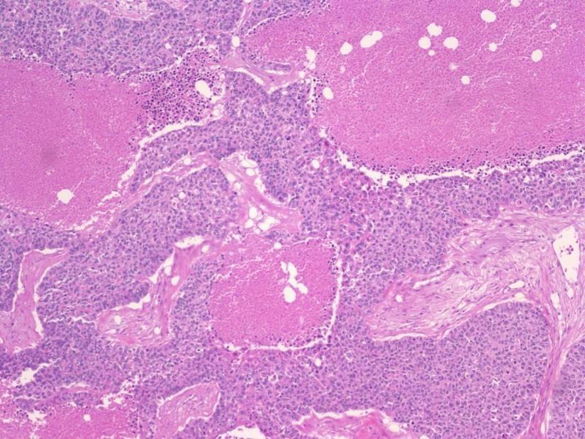 necrosis o Lymphoplasmacytic infiltrate