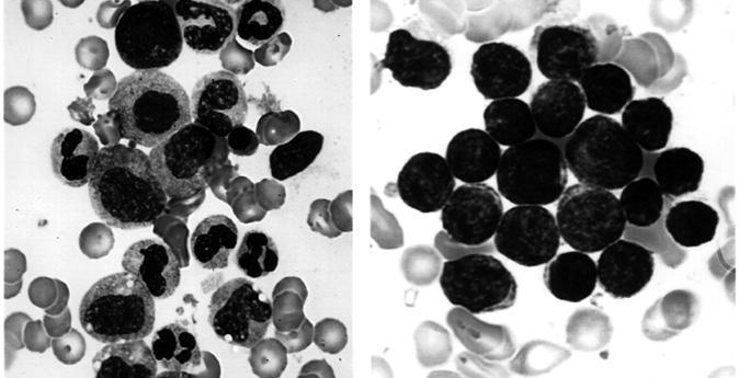 Acute Lymphoblastic Leukemia (ALL) Cells Panel A Panel B Figure 1. Panel A shows a photograph of developing cells in healthy marrow.
