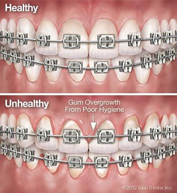 Ortho Hygiene You already know that maintaining good oral hygiene is important for everyone but when you re having orthodontic treatment, it s even more critical. Why?
