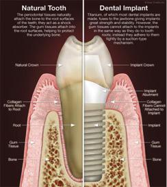 Implant Hygiene Infection Is The Enemy Cleaning implant-supported tooth replacements is just as important as cleaning natural teeth, as both depend on healthy surrounding tissues for support.