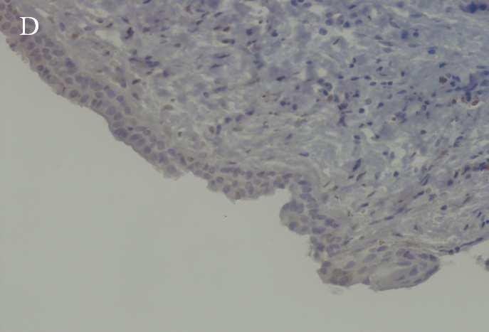 ameloblastoma,