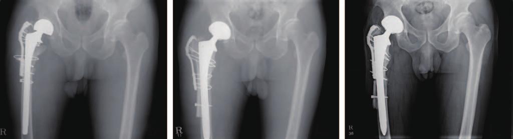 Jun Sung Park et al. Results of Strut Allografts Treating Periprosthetic Bone Defects time to incorporation (P=0.494).