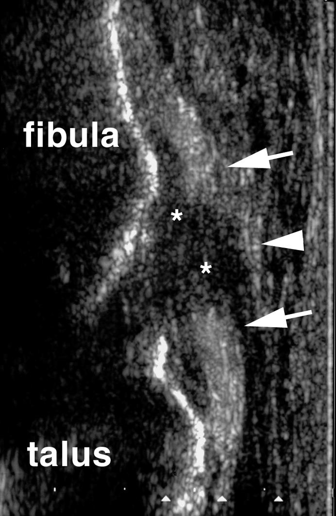 IMAGING TECHNIQUES 4.2. Ultrasound Ultrasound is the main alternative to MR imaging in the evaluation of soft-tissue abnormalities.