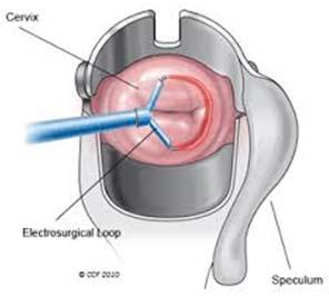 Loop Electrosurgical Excision Procedure Excisional procedure Locate lesion and select