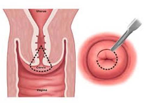 ECC done Cauterize cervix / stitches / monsel Higher cure rates for