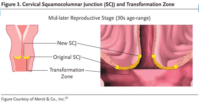 Transformation Zone Area between the original squamo columnar junction and the new squamo columnar junction Cervical neoplasia arises in this area HPV and cervical cancer HOW?