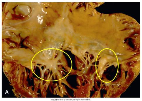 Carcinoid Heart Disease Clinical Characteristics Causes stenosis or regurgitation of valves of the right heart Substance inducing fibrosis released from metastatic liver