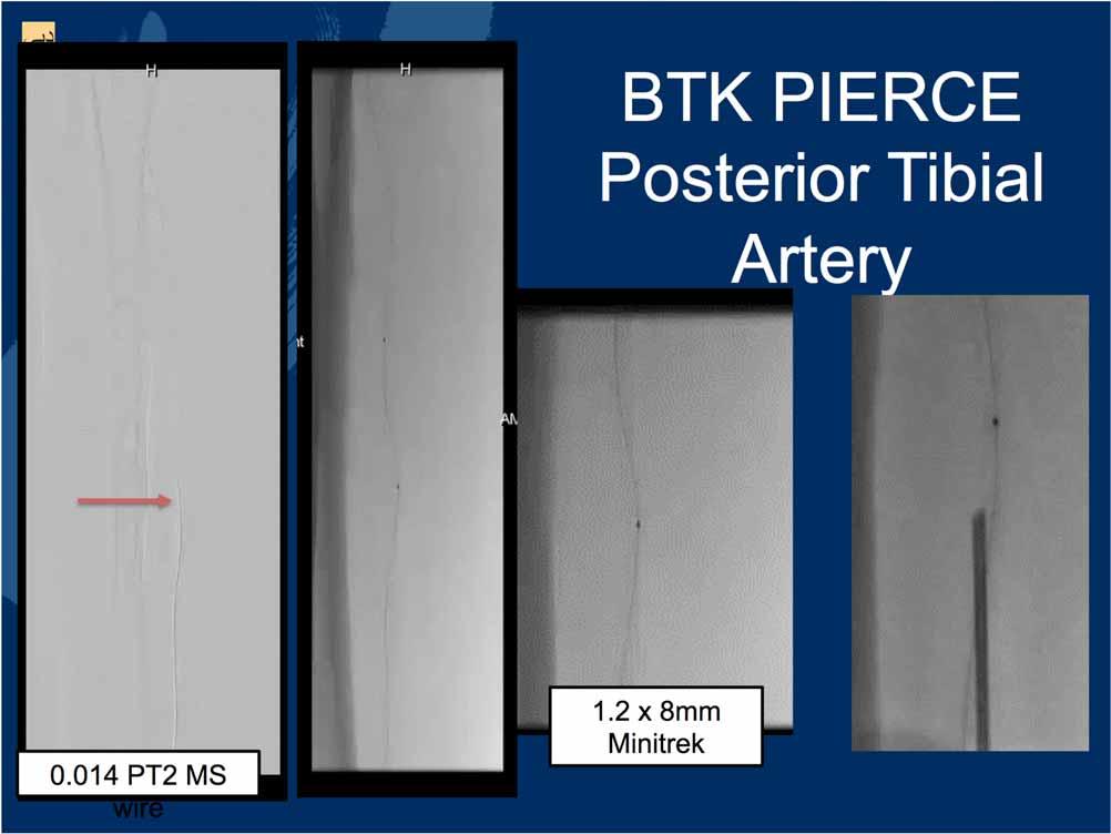 BTK PIERCE Posterior Tibial Artery 0.