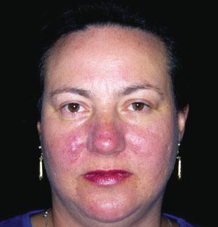 Rosacea: a symptom-based approach to management Edward Seaton MA, MRCP VM Rosacea is a common skin condition of unknown aetiology.