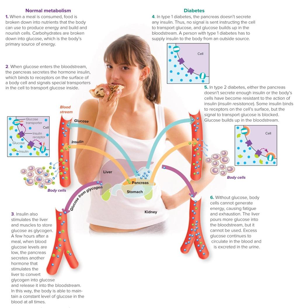 Figure 14.3 Diabetes Mellitus During digestion, carbohydrates are broken down in the small intestine into glucose, a simple sugar that enters the bloodstream.