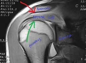 R.C.D - Impingement Syndrome X-ray: Calcification Degenerated AC jt.