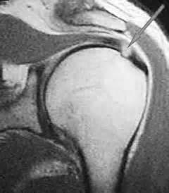 R.C.D - Rotator Cuff Tear Clinical features: Move: Incomplete