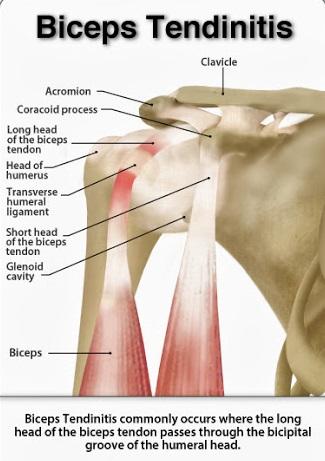 head of biceps tendon: Pain Deformity