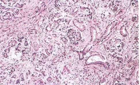 Chronic Pancreatitis: Imaging Histology Fibrosis Scattered foci of