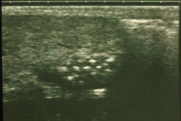 Imaging Modalities Abdominal ultrasound Dilated