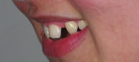 clearly separated middle incisors as well as further malpositions in the upper anterior region (Figures 3 8).