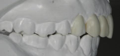 Next, the maxillary anterior teeth 13-23 were selectively conditioned for just 5-10 seconds using phosphoric acid, the acid was rinsed off and an