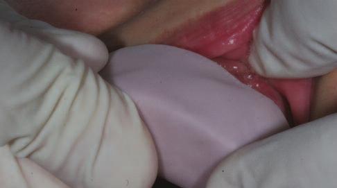 Due to the prior adhesive stage, the restoration remains in the mouth during this time.