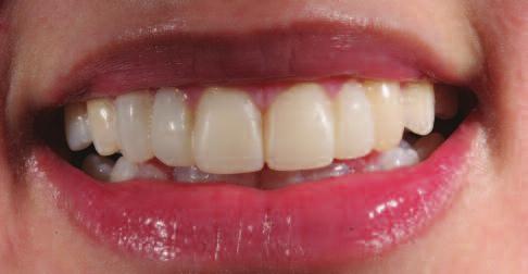 When the forced smile prior to the treatment is compared with the smile after finishing the temporary