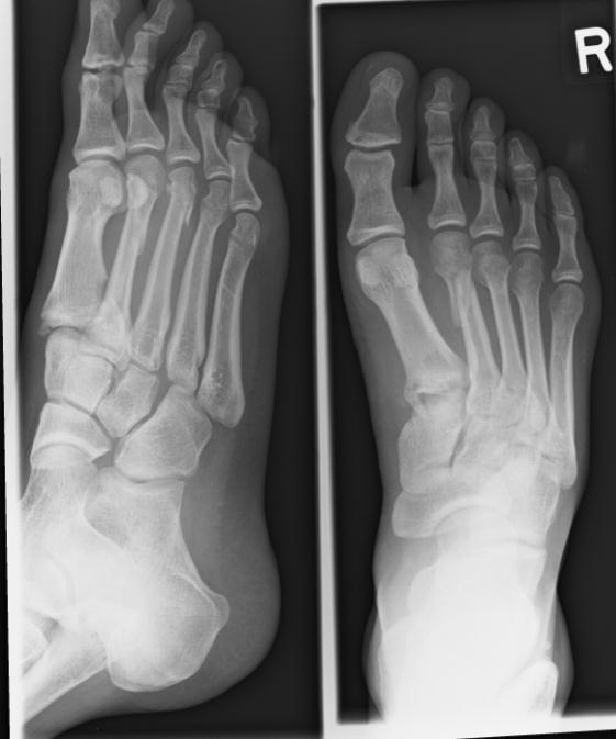Radiography 3 views of foot (AP,