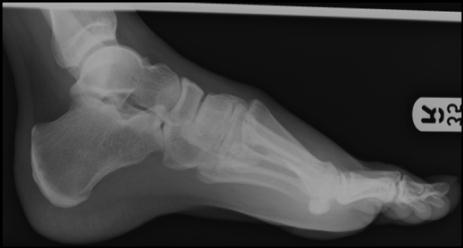ankle (mortise, lateral)