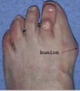 Hallux Valgus (bunion) bunion : lay term for enlarged medial