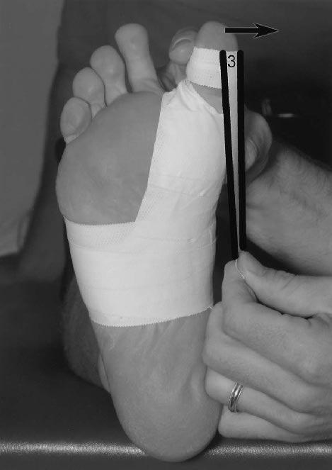 Hallux Valgus: treatment Non-operative: wide toe box to