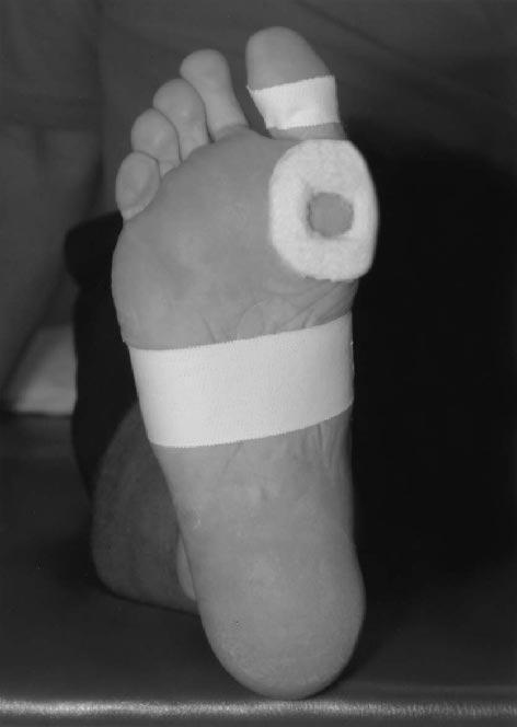 orthotics (arch support, metatarsal bar) physiotherapy (calf