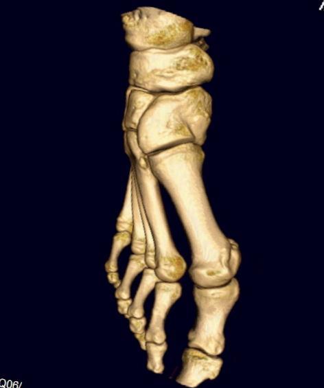 Lisfranc injuries TMTJ (Lisfranc) articulation is an osseous +