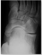 wears badly may see os naviculare on X-ray (as shown)