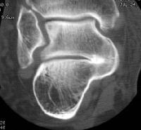 Talocalcaneal C sign restriction in hindfoot-midfoot movement significant