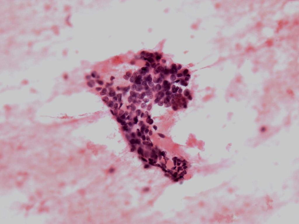 FNA of HPV+