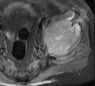 Advanced techniques : MRI Dynamic contrast enhanced (DCE) MRI Tissue characterization Highly