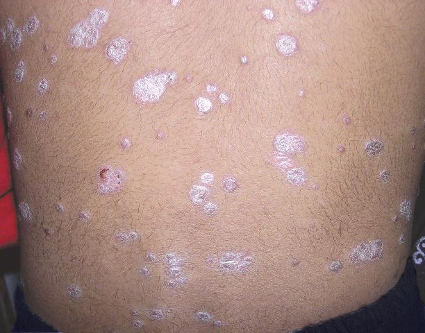 healthy 12-year-old girl came to the office with a 1-year history of a symmetric, generalized scaly eruption. These skin plaques did not itch; she had no recent history of sore throat.