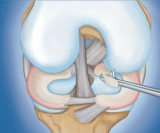 Knee Arthroscopy Meniscus Surgery FAQ Ryan W. Hess, MD Office: 763-302-2223 Fax: 763-302-2402 Twitter: RyanHessMD Q: WHAT IS ACCOMPLISHED DURING THE PROCEDURE?