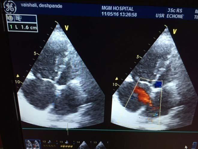 FIGURES: Fig 1 - Trans thoracic echocardiography (TTE) in