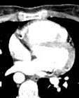 Clue #1 is CT scan A case from Ann Pediatr Cardiol.