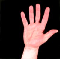 Advanced Pathophysiology Unit 8: Acid/Base/Lytes Page 4 of 31 Allen s test: Note the normal color of the palmar surface of the hand (pink from perfusion) Now, Allen s test is blanching the hand