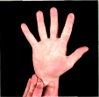 perfusing the hand This person can now have an arterial stick for a blood gas even if a hematoma develops that obstructs the radial artery, the ulnar artery alone will be able to maintain adequate