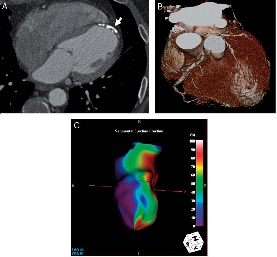 J Thorac Imaging Volume 22, Number 1, February 2007 FIGURE 8. Contrast enhanced, retrospectively ECG-gated dual-source CTA in a 69-year-old man after LAD infarction.